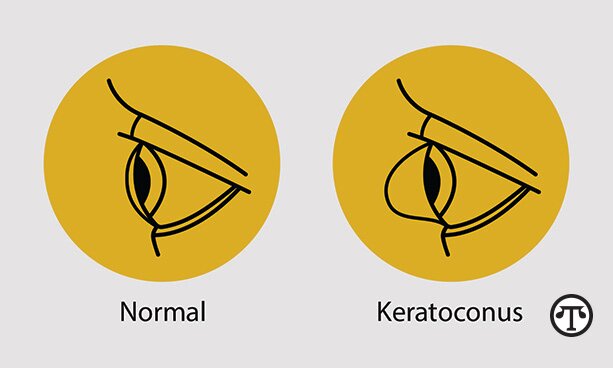World Keratoconus Day Aims to Increase Awareness About This Progressive Eye Disease