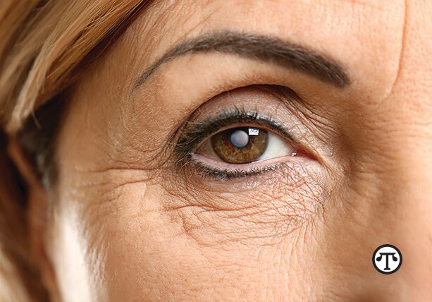 What You Need to Know About Cataracts